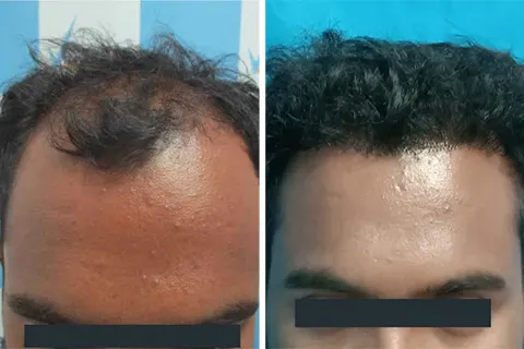 Hair rejuvation therapy before photo in VCare